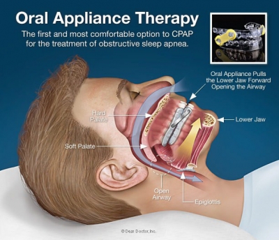 Gregory J. Daniels DDS Offers Dental Appliances as Treatment for Obstructive Sleep Apnea